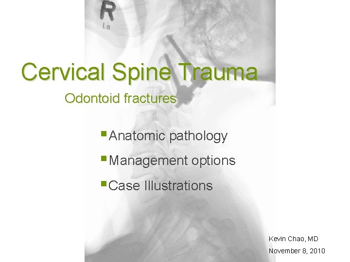 Cervical Spine Trauma Odontoid fractures § Anatomic pathology § Management options § Case Illustrations