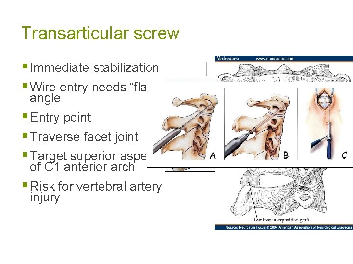 Transarticular screw § Immediate stabilization § Wire entry needs “flat” angle § Entry point