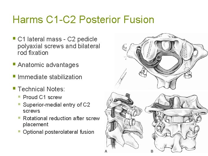 Harms C 1 -C 2 Posterior Fusion § C 1 lateral mass - C