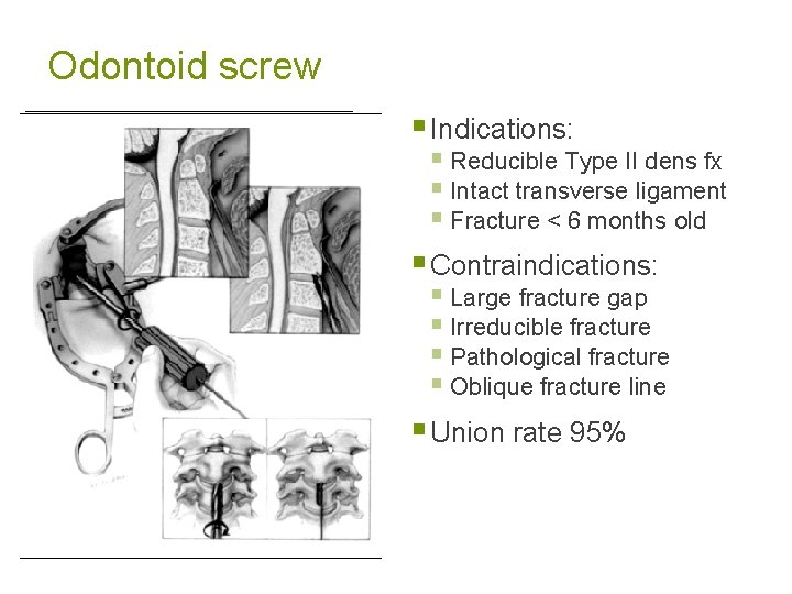 Odontoid screw § Indications: § Reducible Type II dens fx § Intact transverse ligament