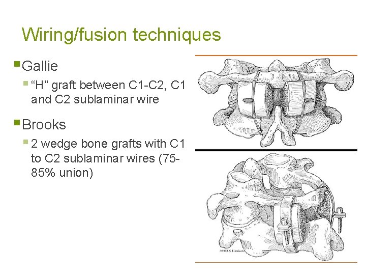 Wiring/fusion techniques § Gallie § “H” graft between C 1 -C 2, C 1