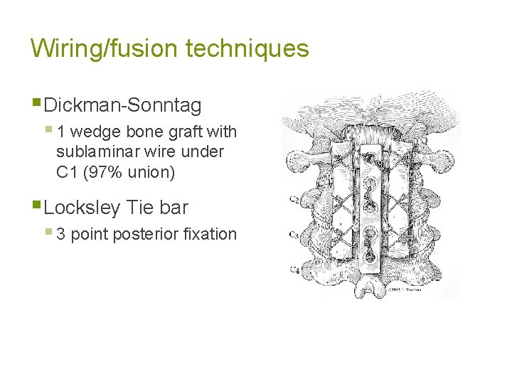 Wiring/fusion techniques § Dickman-Sonntag § 1 wedge bone graft with sublaminar wire under C