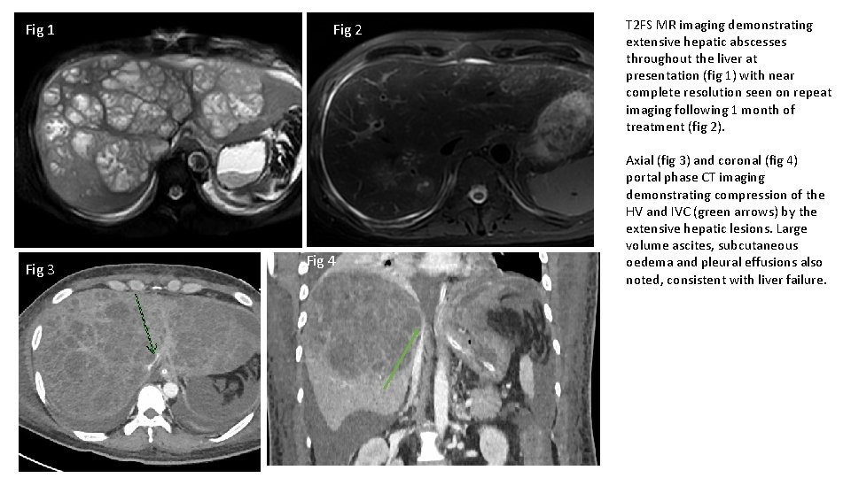 Fig 1 Fig 3 Fig 2 Fig 4 T 2 FS MR imaging demonstrating