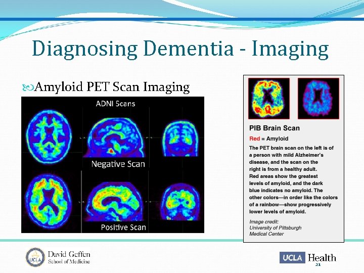 Diagnosing Dementia - Imaging Amyloid PET Scan Imaging 21 
