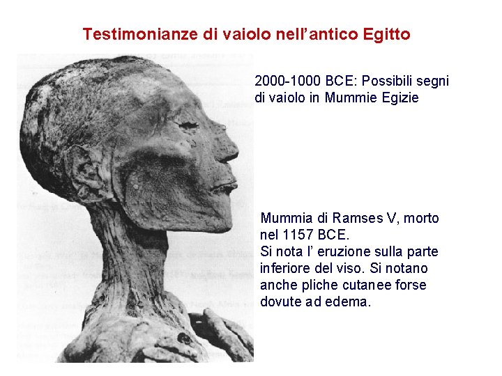 Testimonianze di vaiolo nell’antico Egitto 2000 -1000 BCE: Possibili segni di vaiolo in Mummie