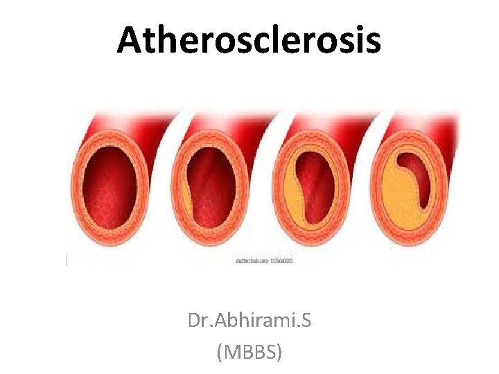 Atherosclerosis Dr. Abhirami. S (MBBS) 