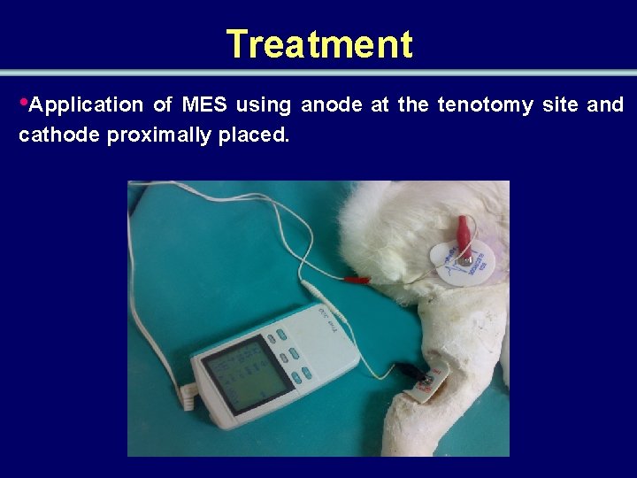 Treatment • Application of MES using anode at the tenotomy site and cathode proximally