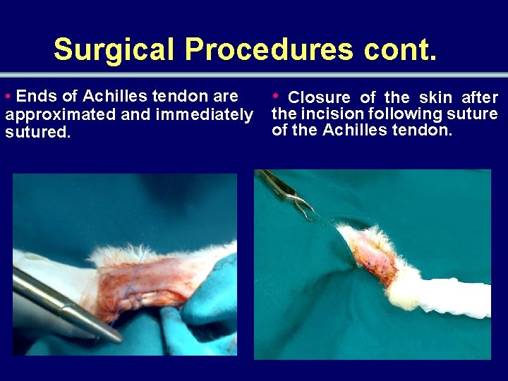 Surgical Procedures cont. • Ends of Achilles tendon are approximated and immediately sutured. •