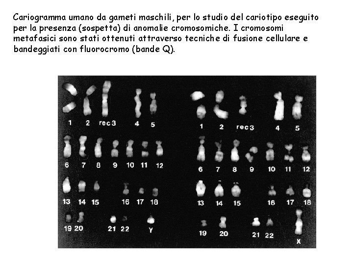 Cariogramma umano da gameti maschili, per lo studio del cariotipo eseguito per la presenza