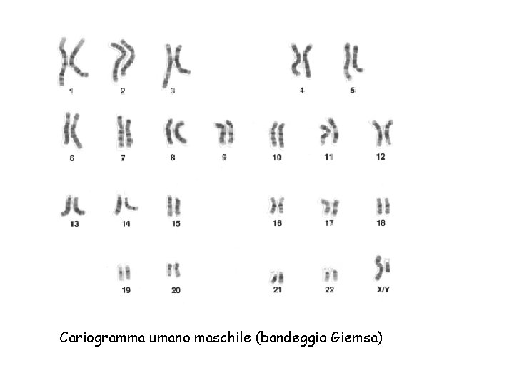 Cariogramma umano maschile (bandeggio Giemsa) 