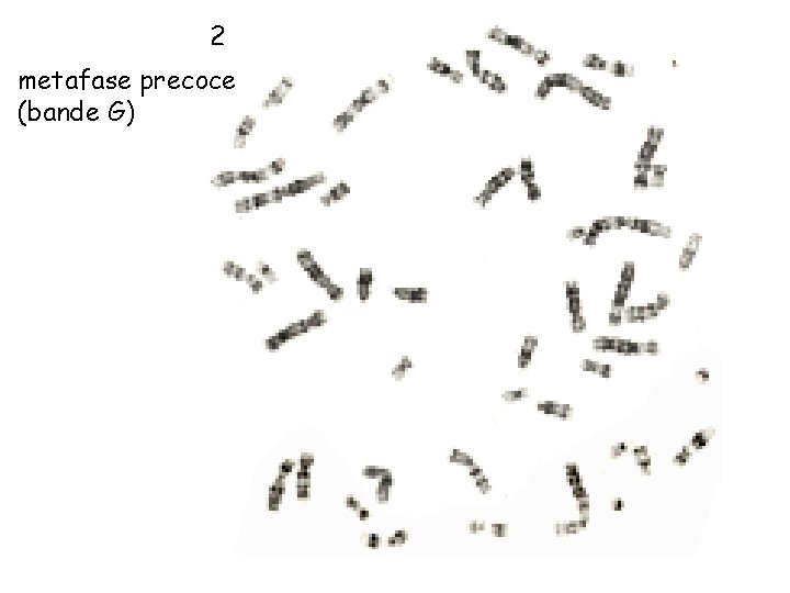 2 metafase precoce (bande G) 