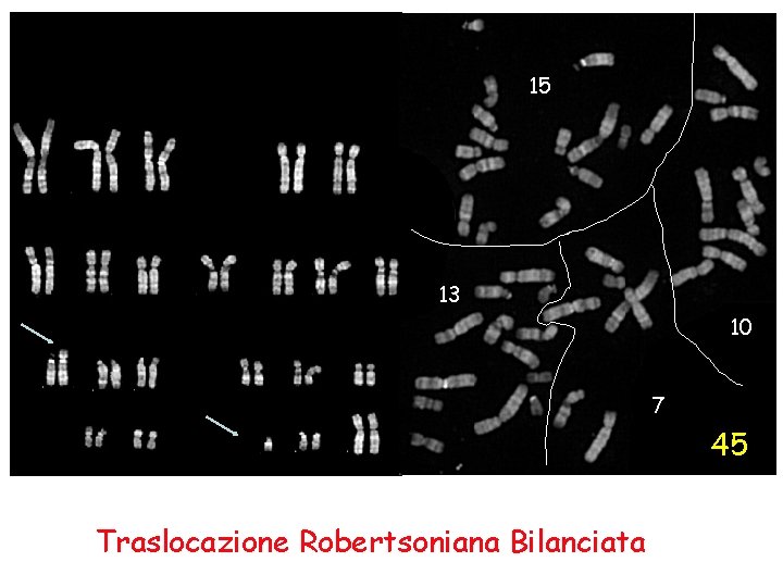 15 13 10 7 45 Traslocazione Robertsoniana Bilanciata 