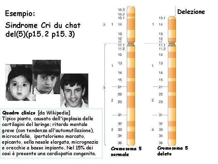 Delezione Esempio: Sindrome Cri du chat del(5)(p 15. 2 p 15. 3) Quadro clinico