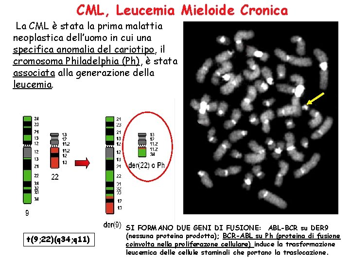 CML, Leucemia Mieloide Cronica La CML è stata la prima malattia neoplastica dell’uomo in