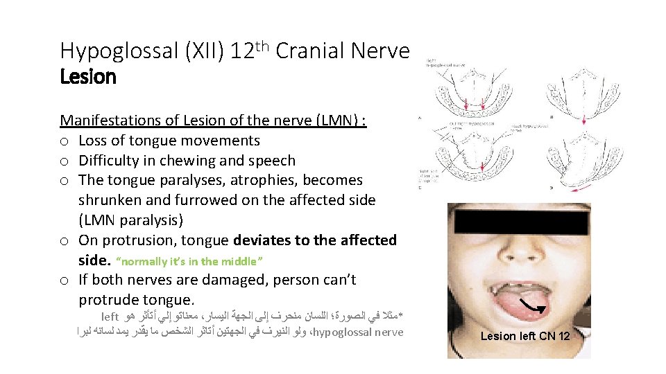 Hypoglossal (XII) 12 th Cranial Nerve Lesion Manifestations of Lesion of the nerve (LMN)