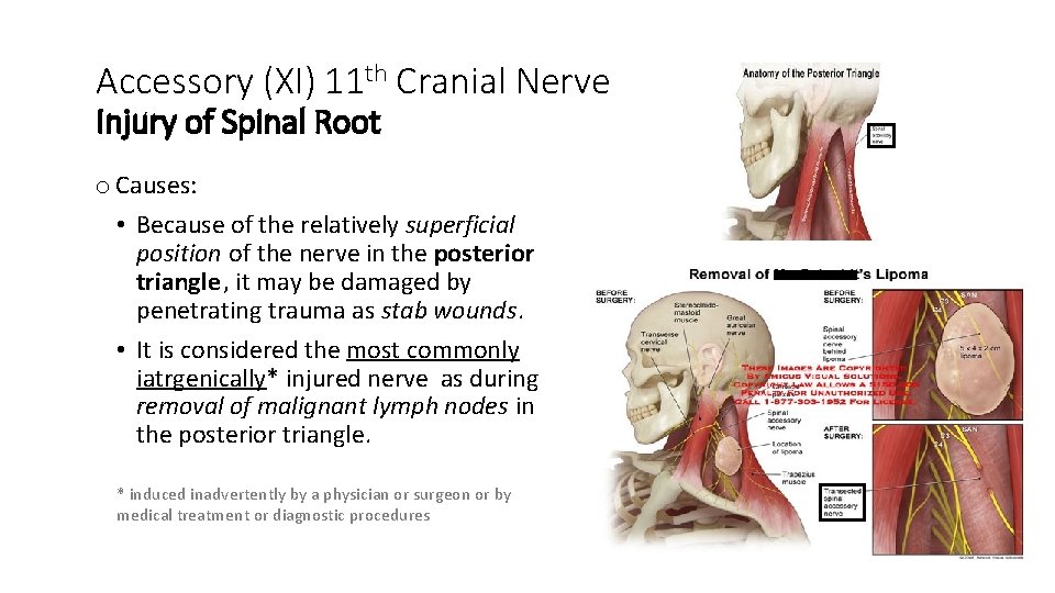 Accessory (XI) 11 th Cranial Nerve Injury of Spinal Root o Causes: • Because