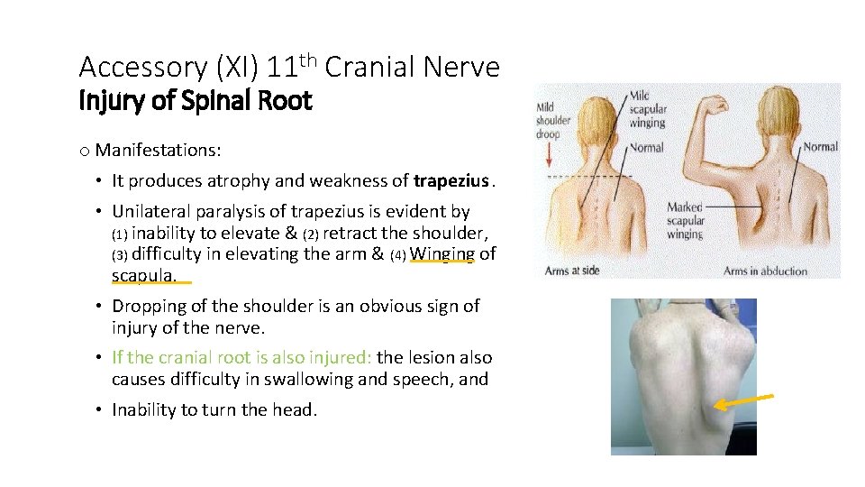Accessory (XI) 11 th Cranial Nerve Injury of Spinal Root o Manifestations: • It