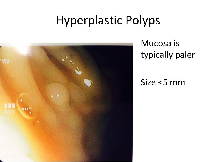 Hyperplastic Polyps Mucosa is typically paler Size <5 mm 