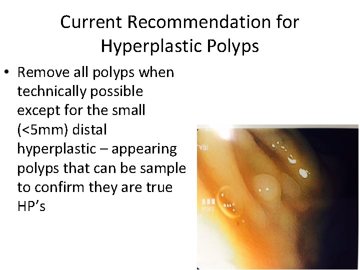 Current Recommendation for Hyperplastic Polyps • Remove all polyps when technically possible except for
