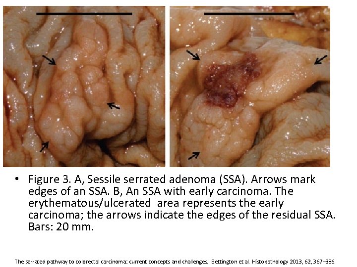  • Figure 3. A, Sessile serrated adenoma (SSA). Arrows mark edges of an