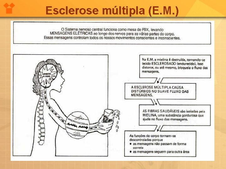 Esclerose múltipla (E. M. ) 