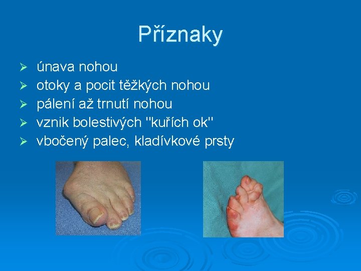 Příznaky Ø Ø Ø únava nohou otoky a pocit těžkých nohou pálení až trnutí