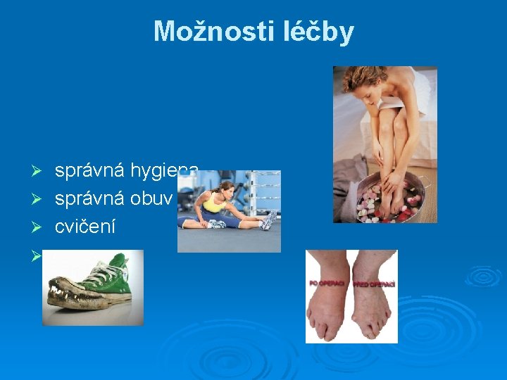 Možnosti léčby Ø Ø správná hygiena správná obuv cvičení operace 