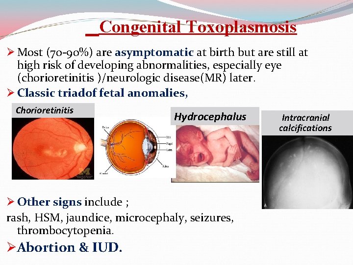 Congenital Toxoplasmosis Ø Most (70 -90%) are asymptomatic at birth but are still at