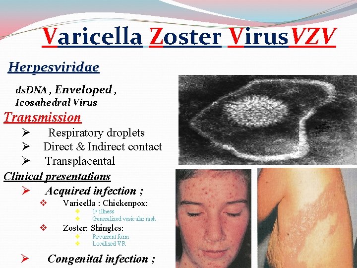 Varicella Zoster Virus. VZV Herpesviridae ds. DNA , Enveloped , Icosahedral Virus Transmission Ø