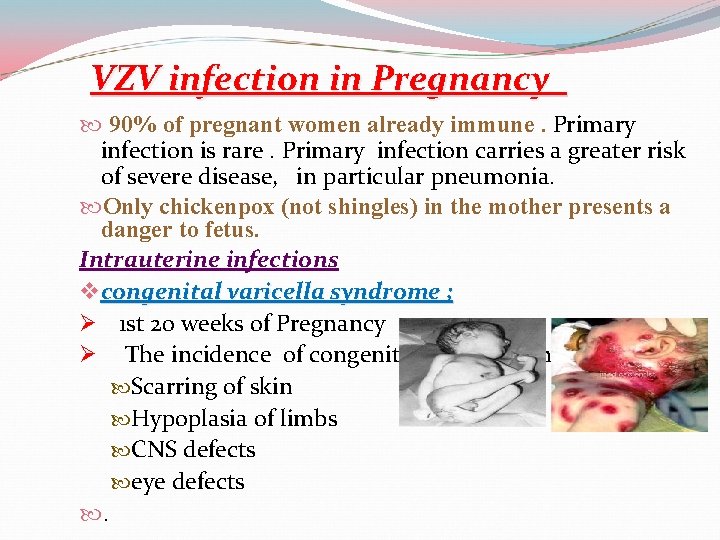 VZV infection in Pregnancy 90% of pregnant women already immune. Primary infection is rare.