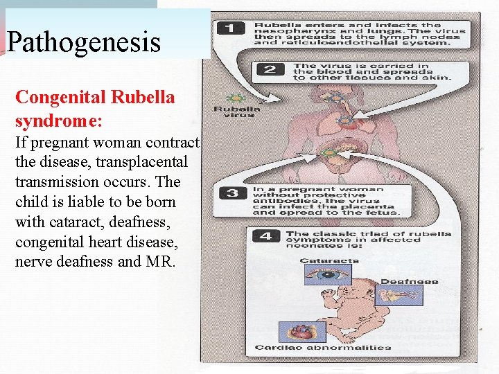 Pathogenesis Congenital Rubella syndrome: If pregnant woman contract the disease, transplacental transmission occurs. The