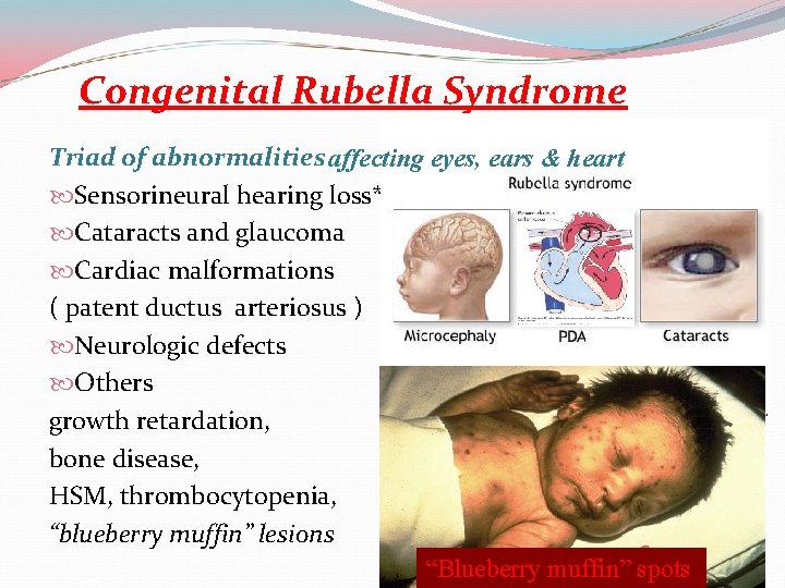 Congenital Rubella Syndrome Triad of abnormalities affecting eyes, ears & heart Sensorineural hearing loss*