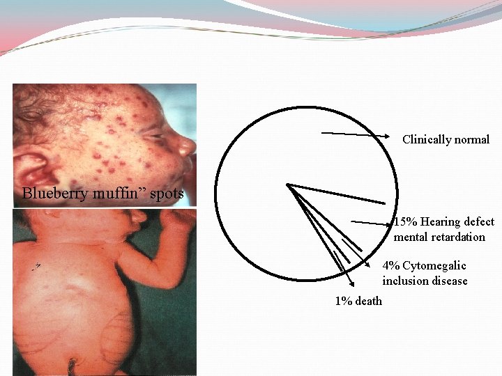Clinically normal Blueberry muffin” spots 15% Hearing defect mental retardation 4% Cytomegalic inclusion disease