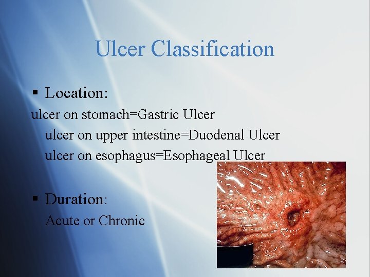 Ulcer Classification Location: ulcer on stomach=Gastric Ulcer ulcer on upper intestine=Duodenal Ulcer ulcer on