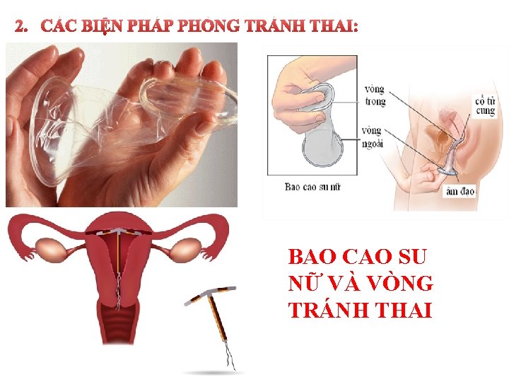 2. CÁC BIỆN PHÁP PHÒNG TRÁNH THAI: BAO CAO SU NỮ VÀ VÒNG TRÁNH