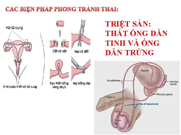 CÁC BIỆN PHÁP PHÒNG TRÁNH THAI: TRIỆT SẢN: THẮT ỐNG DẪN TINH VÀ ỐNG