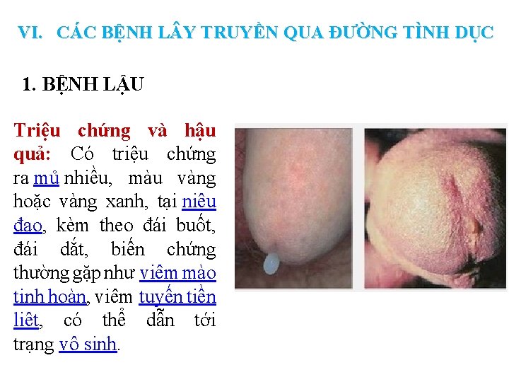 VI. CÁC BỆNH L Y TRUYỀN QUA ĐƯỜNG TÌNH DỤC 1. BỆNH LẬU Triệu