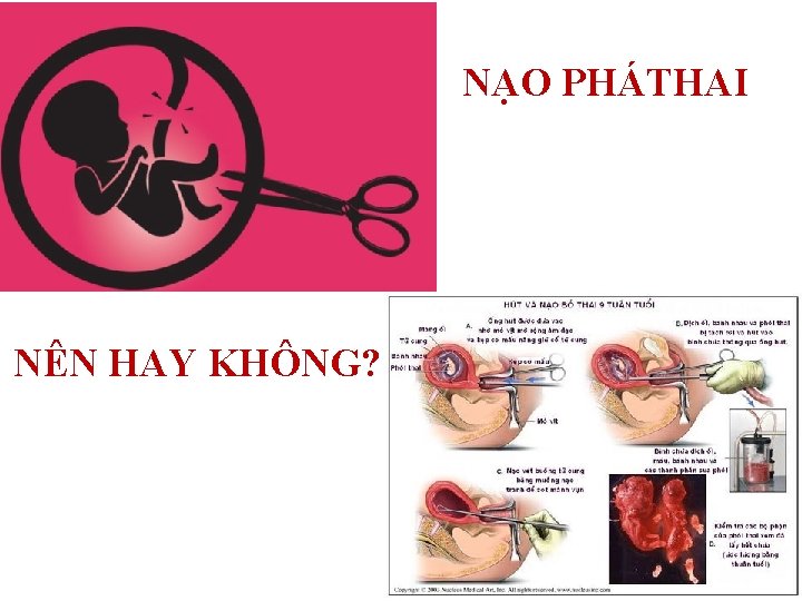 NẠO PHÁTHAI NÊN HAY KHÔNG? 