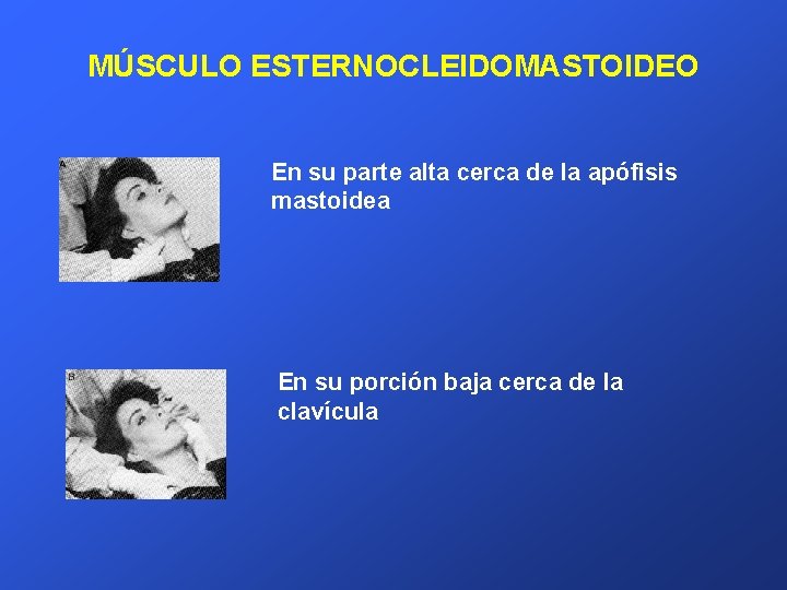 MÚSCULO ESTERNOCLEIDOMASTOIDEO En su parte alta cerca de la apófisis mastoidea En su porción