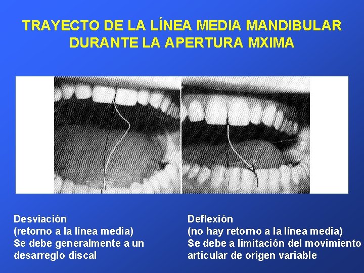 TRAYECTO DE LA LÍNEA MEDIA MANDIBULAR DURANTE LA APERTURA MXIMA Desviación (retorno a la