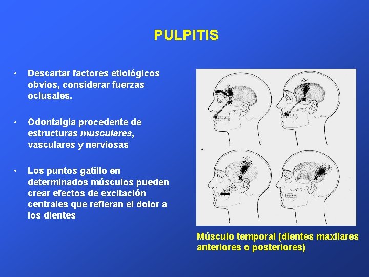 PULPITIS • Descartar factores etiológicos obvios, considerar fuerzas oclusales. • Odontalgia procedente de estructuras