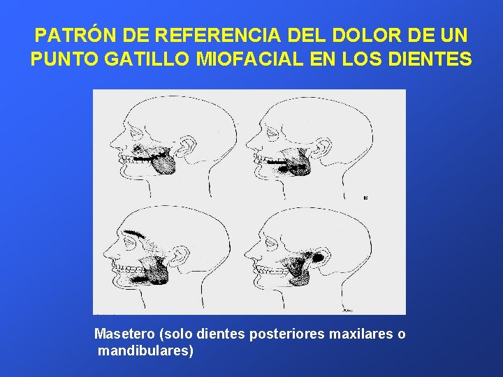 PATRÓN DE REFERENCIA DEL DOLOR DE UN PUNTO GATILLO MIOFACIAL EN LOS DIENTES Masetero