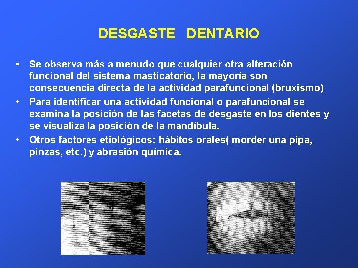 DESGASTE DENTARIO • Se observa más a menudo que cualquier otra alteración funcional del