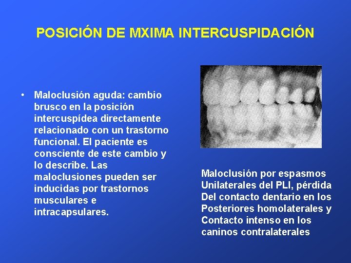 POSICIÓN DE MXIMA INTERCUSPIDACIÓN • Maloclusión aguda: cambio brusco en la posición intercuspídea directamente