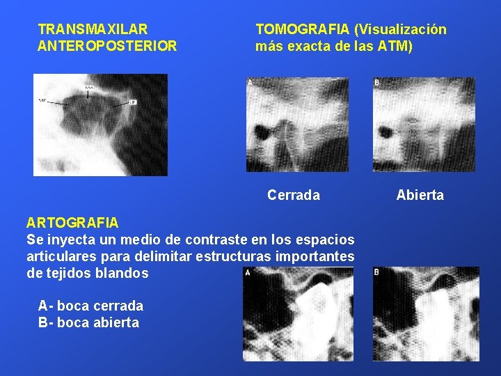 TRANSMAXILAR ANTEROPOSTERIOR TOMOGRAFIA (Visualización más exacta de las ATM) Cerrada ARTOGRAFIA Se inyecta un