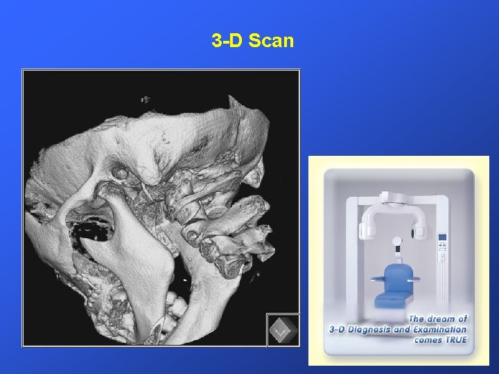 3 -D Scan 