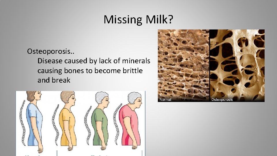 Missing Milk? Osteoporosis. . Disease caused by lack of minerals causing bones to become