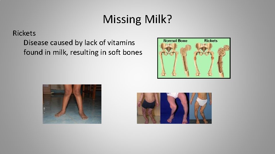 Missing Milk? Rickets Disease caused by lack of vitamins found in milk, resulting in