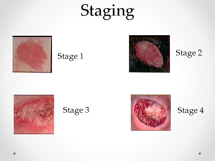 Staging Stage 1 Stage 3 Stage 2 Stage 4 