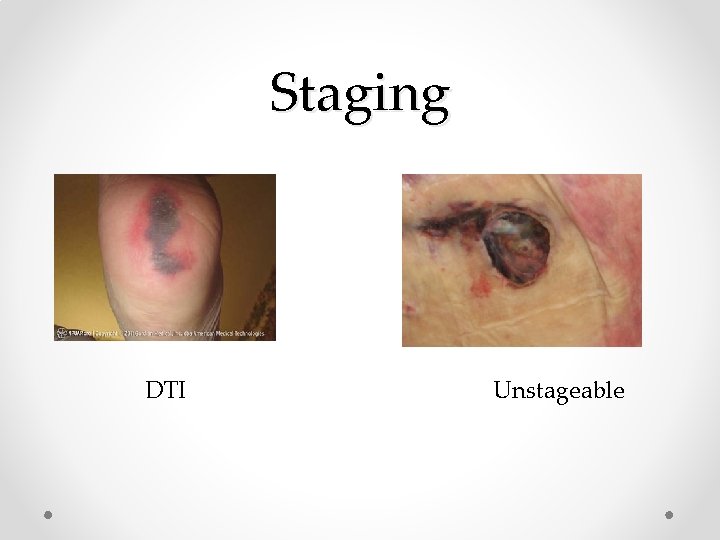 Staging DTI Unstageable 